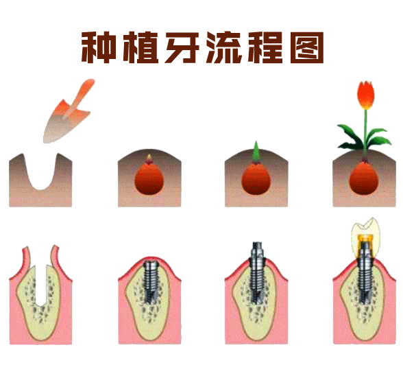 种植牙全流程图解，高清PNG透明图片，PPT/PSD设计素材，一键下载