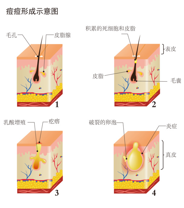 脸部痘痘成因图解，高清PNG透明免抠元素及PSD设计素材下载