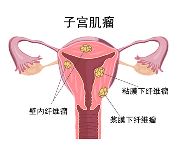 子宫肌瘤 PNG透明图免扣&PSD设计素材高清下载