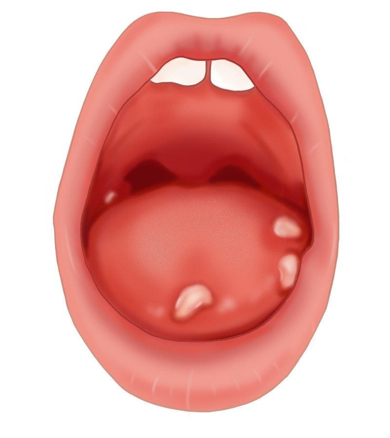 手绘口腔溃疡卡通元素高清透明PNG图片设计素材免费下载