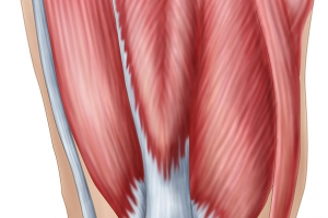 半月板滑膜炎大腿