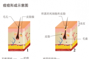 脸部痘痘形成示意图