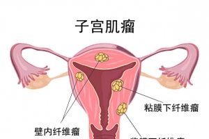 子宫肌瘤 疾病