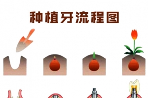 种植牙流程